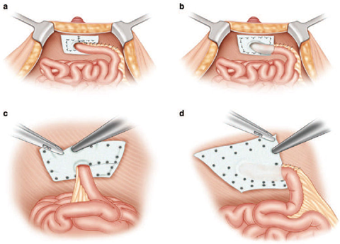 A co prolaps enterostomie? 